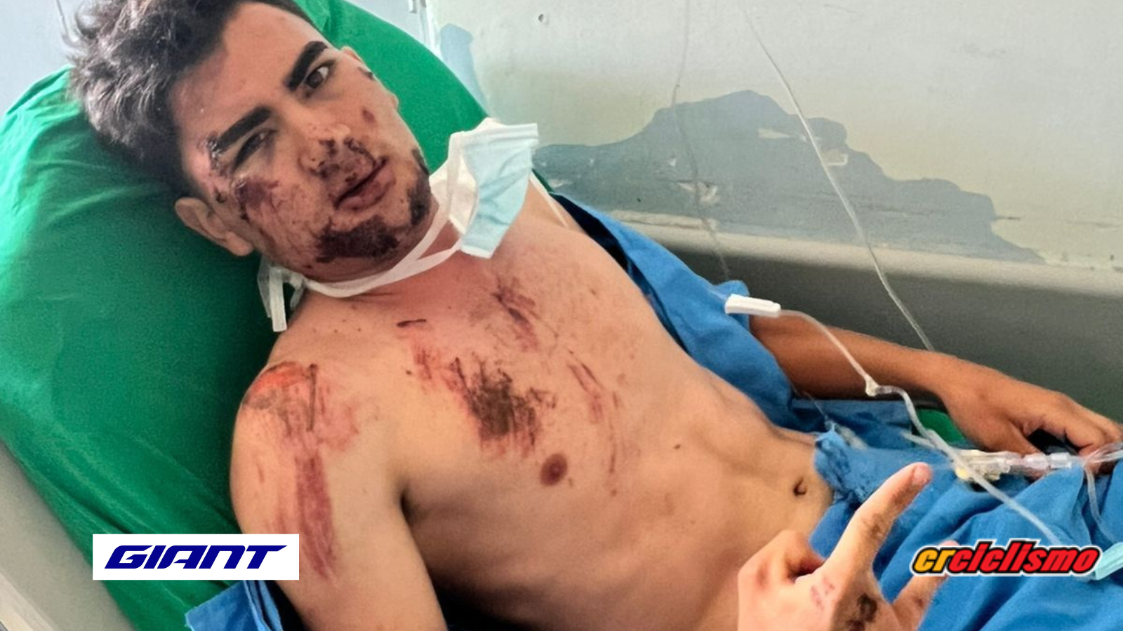 Raymond Gonzáles con fracturas en su cara, fisuras en la mandíbula, clavícula, 3 cirugías y 32 puntos en la cara, tras accidente en Copa Endurance.